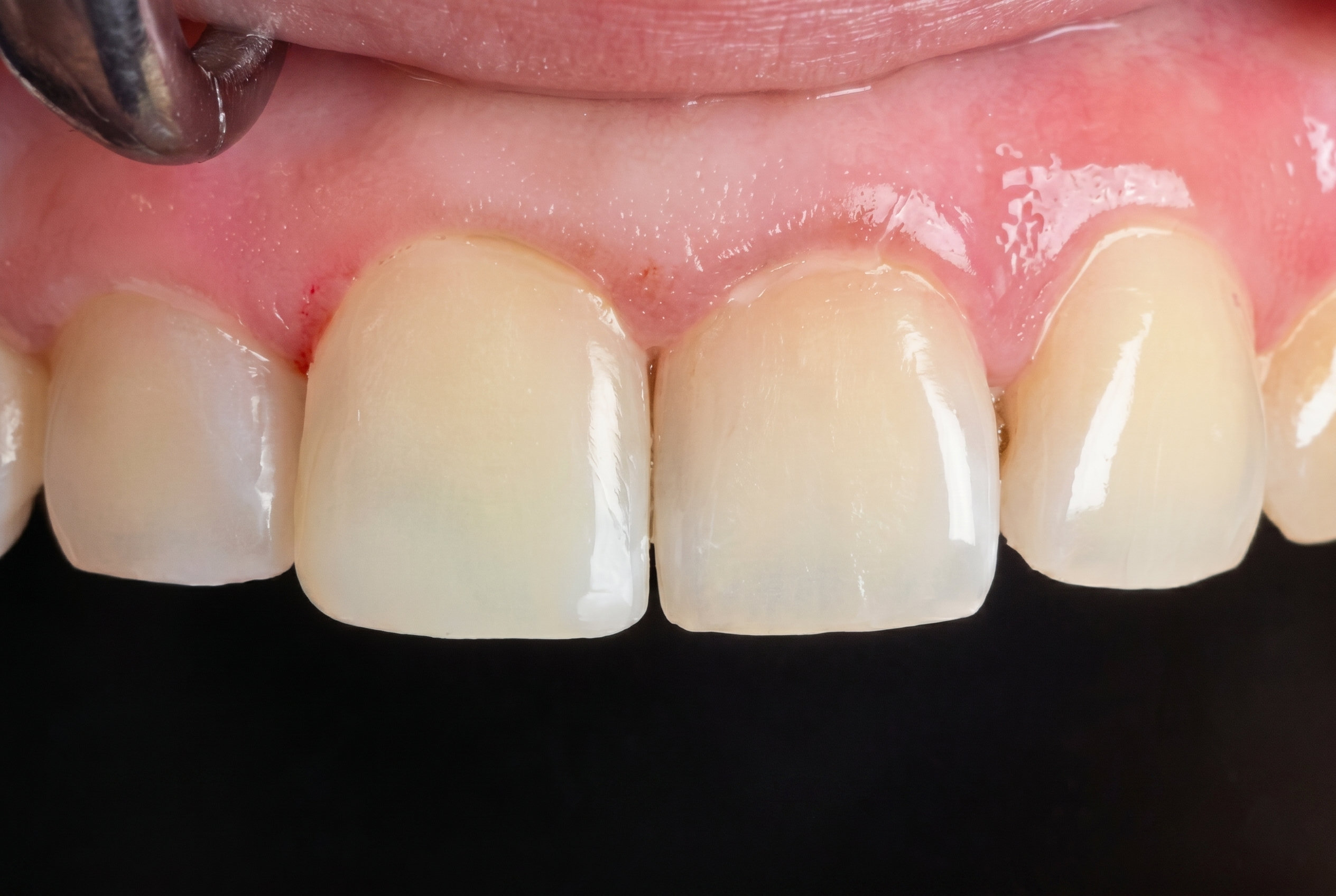 Dental Filling - After
